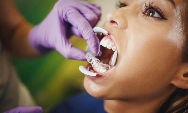 Orthodontie Adulte : Traitements existants